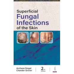 Superficial Fungal Infections of the Skin