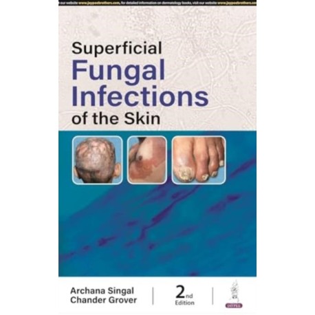 Superficial Fungal Infections of the Skin