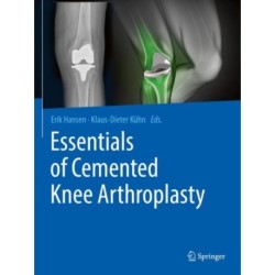 Essentials of Cemented Knee Arthroplasty