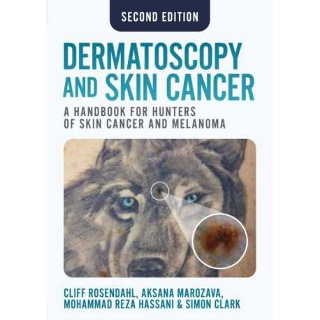 Dermatoscopy and Skin Cancer, second edition: A handbook for hunters of skin cancer and melanoma