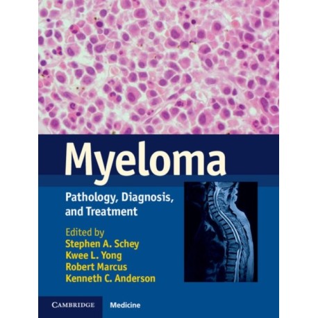 Myeloma: Pathology, Diagnosis, and Treatment