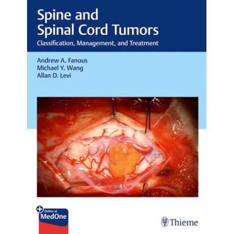 Spine and Spinal Cord Tumors: Classification, Management, and Treatment