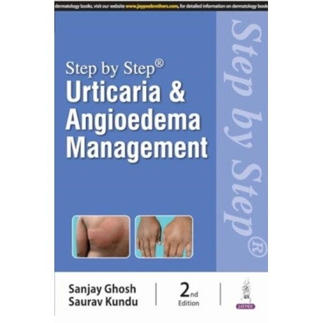 Step by Step: Urticaria & Angioedema Management