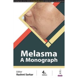 Melasma: A Monograph
