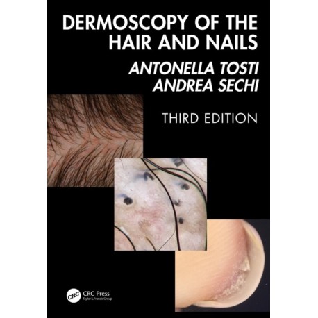 Dermoscopy of the Hair and Nails 3e