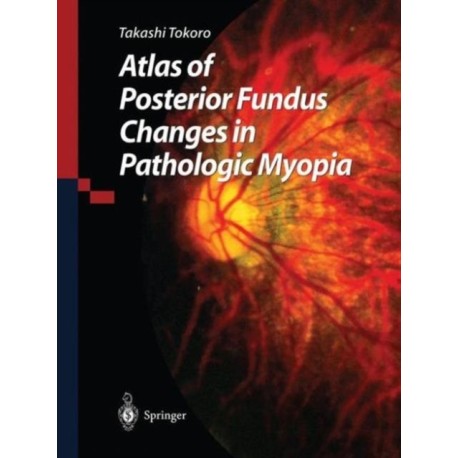 Atlas of Posterior Fundus Changes in Pathologic Myopia