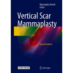 Vertical Scar Mammaplasty