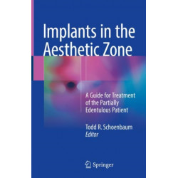 Implants in the Aesthetic Zone: A Guide for Treatment of the Partially Edentulous Patient