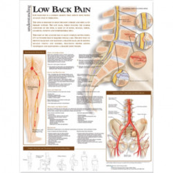 Understanding Low Back Pain Anatomical Chart