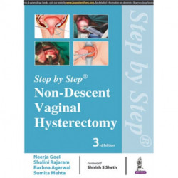 Step by Step: Non-Descent Vaginal Hysterectomy