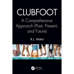 Clubfoot: A Comprehensive Approach (Past, Present, and Future)