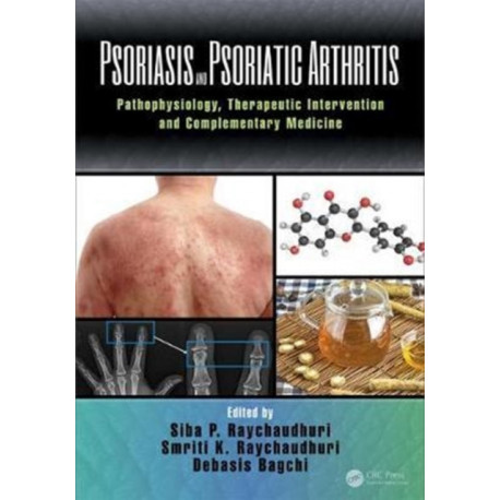Psoriasis and Psoriatic Arthritis: Pathophysiology, Therapeutic Intervention, and Complementary Medicine