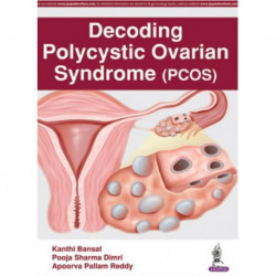Decoding Polycystic Ovarian Syndrome