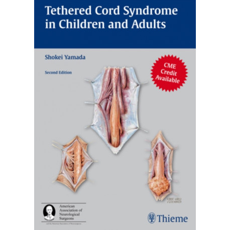 Tethered Cord Syndrome in Children and Adults