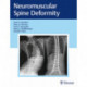Neuromuscular Spine Deformity
