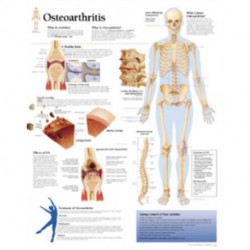 Osteoarthritis Laminated Poster