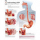 Understanding GERD (Gastroesophageal Reflux Disease) Laminated Poster