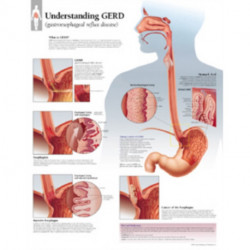 Understanding GERD (Gastroesophageal Reflux Disease) Laminated Poster