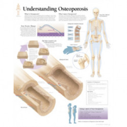 Understanding Osteoporosis Paper Poster