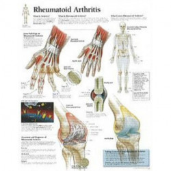 Rheumatoid Arthritis Laminated Poster