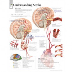 Understanding Stroke Laminated Poster