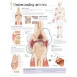 Understanding Arthritis Paper Poster
