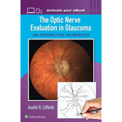 The Optic Nerve Evaluation in Glaucoma: An Interactive Workbook