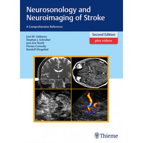 Neurosonology and Neuroimaging of Stroke: A Comprehensive Reference