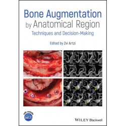 Bone Augmentation by Anatomical Region: Techniques and Decision-Making